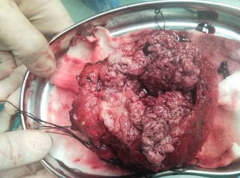 膀胱癌的临床表现