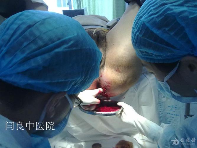 骨盆直肠间隙脓肿