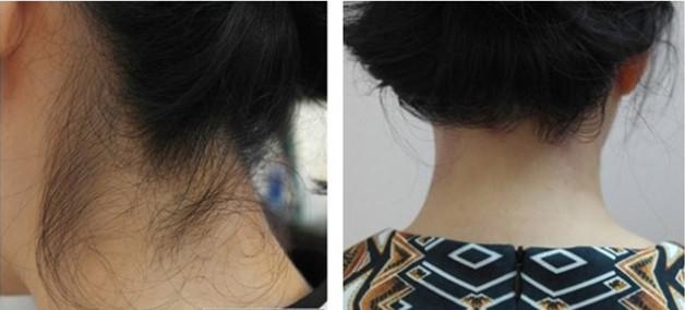 我脱发际线已经4个月了