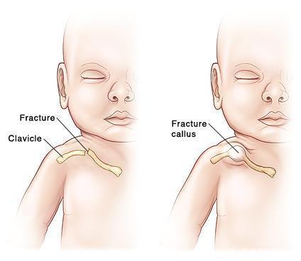 新生儿锁骨骨折了能不手术治疗吗?张医生告诉你真相!