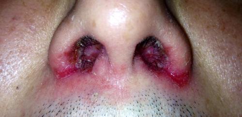 鼻子两边有裂开很长时间了时好时坏但