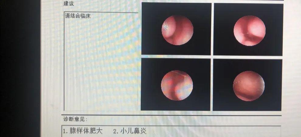 鼻咽镜结果显示,孩子双侧扁桃体肥大,并伴有炎症.