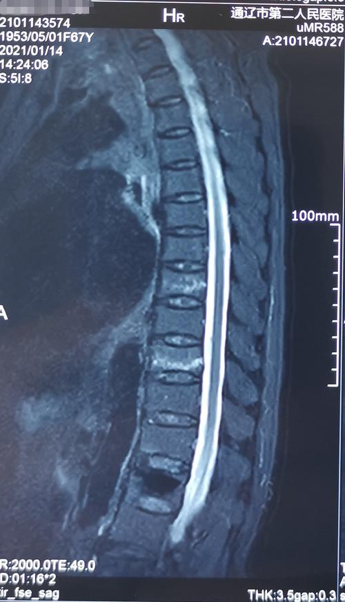 68岁胸椎压缩性骨折椎体成形手术一例
