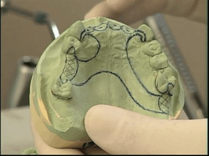 可摘局部义齿-设计图的画法_word文档在线阅读与下载