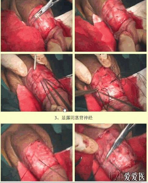 求阴茎背神经阻断术视频