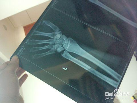 手腕发生扭伤怎么办