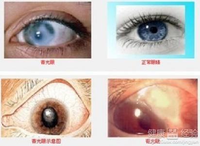 如何预防青光眼