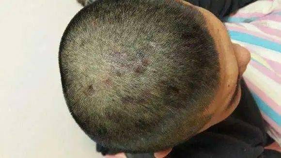 反反复复脂溢性皮炎