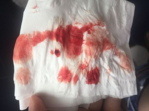 今天我大便完,就看见纸巾上有血!