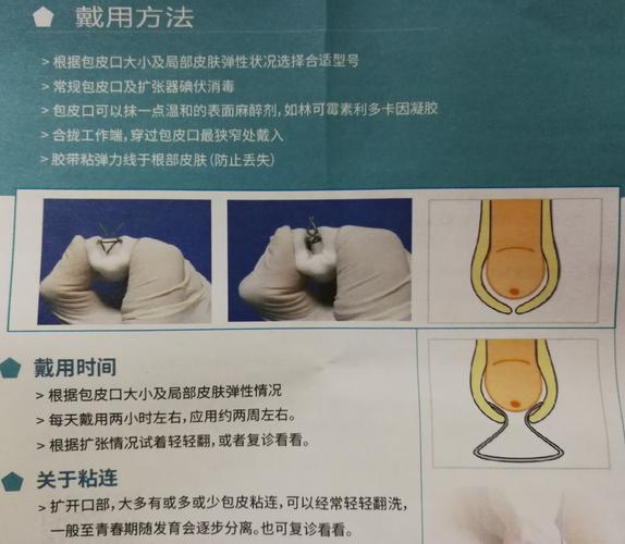 本组包茎扩张器使用注意事项