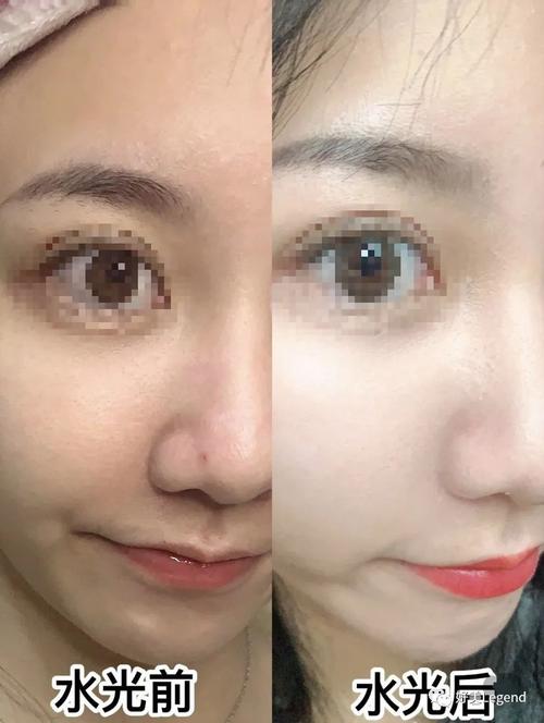 水光针会让皮肤上瘾今天我来为它正名