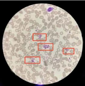 解密消失的血小板之隐身迷案