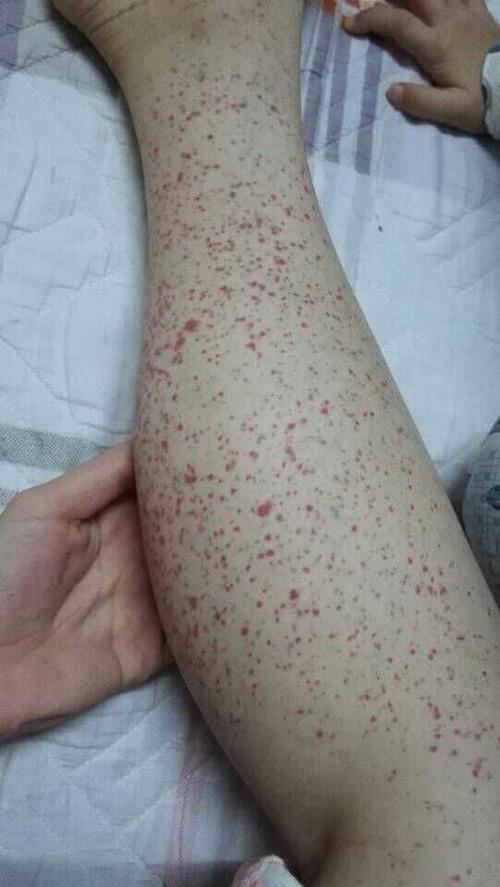 什么是过敏性紫癜我带你认识一下