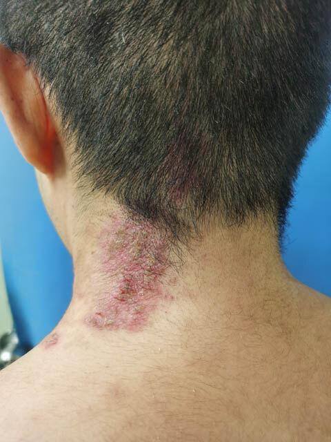 看图说话1:毛囊角化病与慢性家族性良性天疱疮