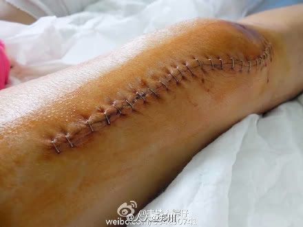 美女主播被撞伤 大腿伤口裂开20厘米触目惊心