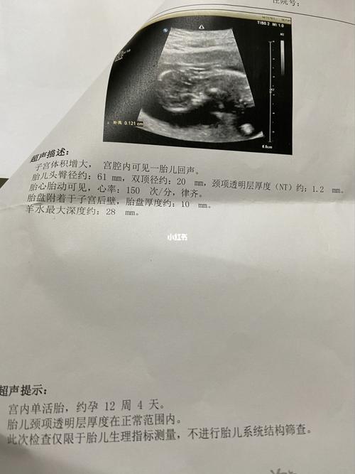 nt单子,有经验的麻烦看看男宝还是女宝_nt检查_女宝_胎儿_母婴_孕产