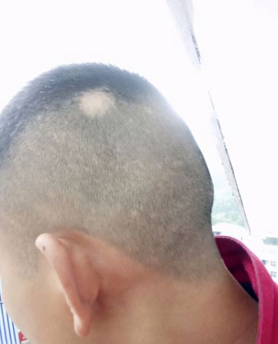 20岁小伙斑秃半年多用了生姜擦头吃过黑芝麻还是没长出头发