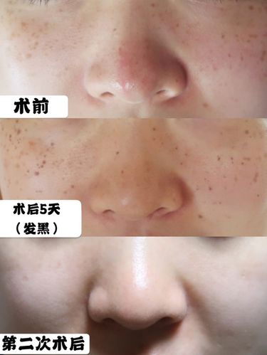 激光祛斑后皮肤反而变黑了,咋回事?