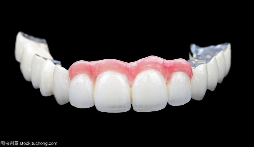 帮你揭露烤瓷牙与全瓷牙的区别!_金属