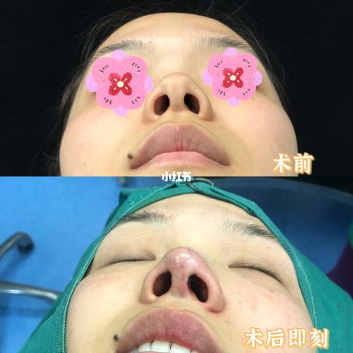 内切鼻翼会留疤吗_变美_隆鼻_塑型_隆鼻变美分享_美妆
