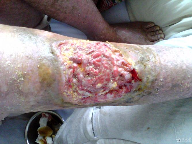 求妙方——小腿溃疡 - 皮肤及性传播疾病讨论版 - 爱爱医医学论坛