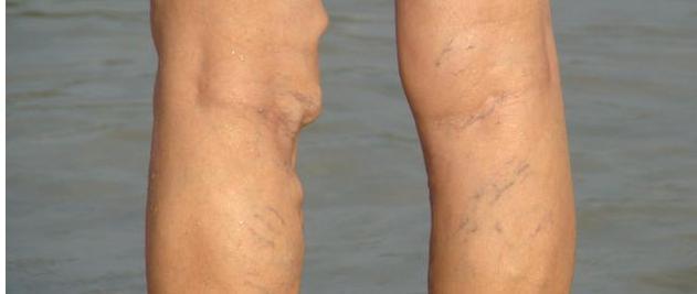 小腿出现3大症状, 表明血管动脉硬化严重, 不想双腿废