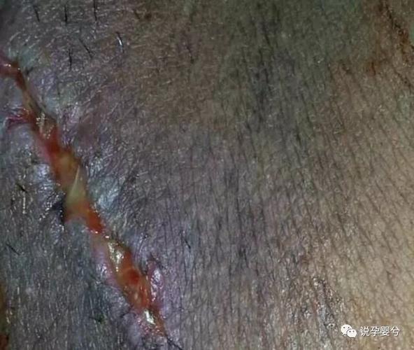 生孩子时侧切和撕裂哪个更令人恐惧? 两者有何区别?