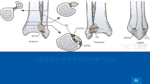 下胫腓联韧带损伤.ppt