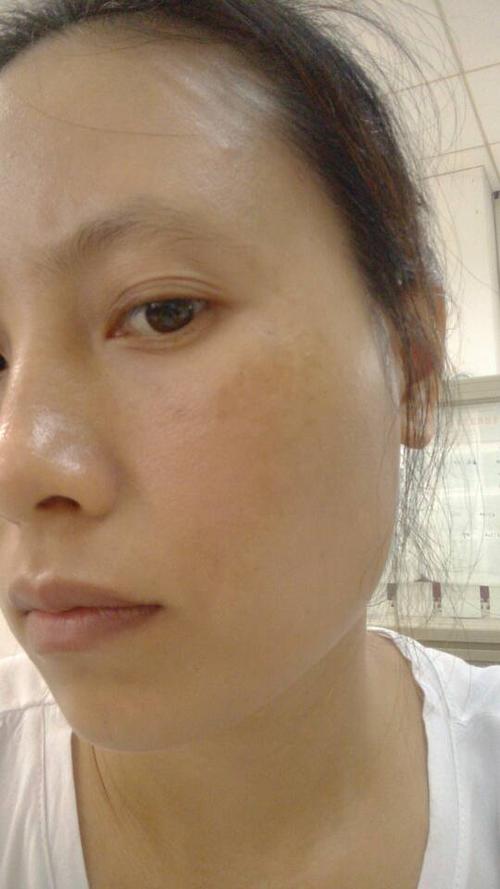 问:请问我脸上的斑怎样去掉,用什么方法去,越快越好!