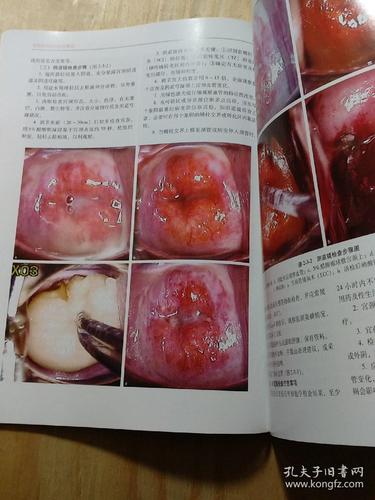 子宫颈病变的诊治要点