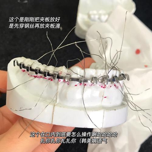 今天做牙弓夹板!