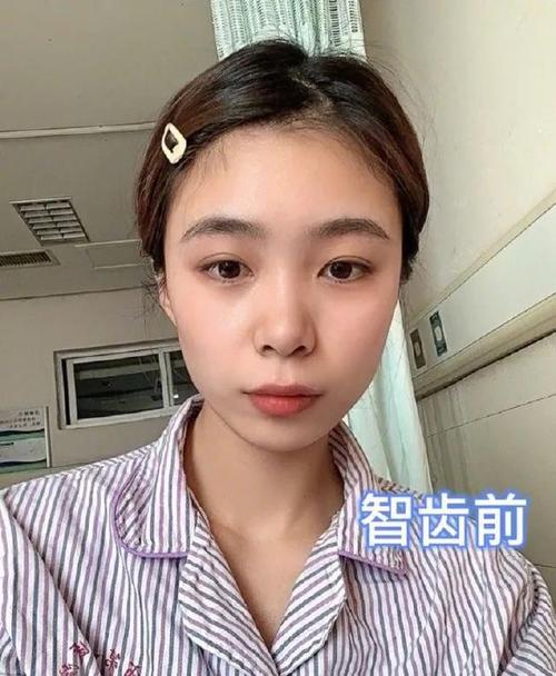 拔智齿前后的脸型变化……哈哈哈哈哈这是松鼠精转世吗?