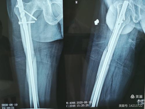 术后五月复查,骨折获得良好愈合.