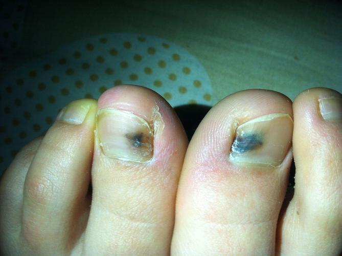 女 脚大拇指趾甲为什么有黑色的 不痛不痒 看起来好像里面有淤血 这是