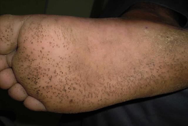 窝状角质松解症图片