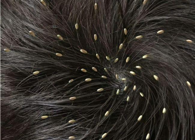 30年前男女老少都有虱子,为什么现在没有了?虱子都是从哪来的?