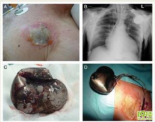 百多力起搏器装了一个月就出问题!