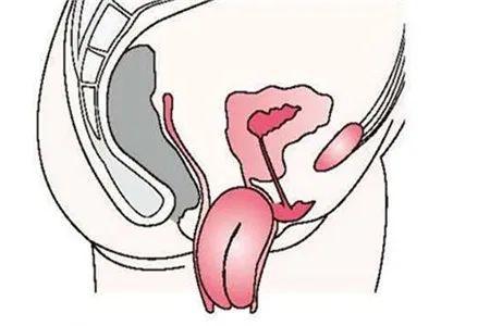 子宫脱垂的危害以及预防的方法