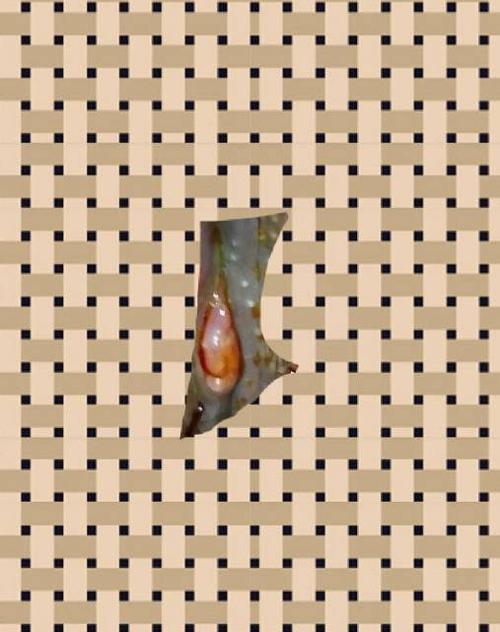 如图,顺产会阴撕裂缝针30天.这点肉是怎么回事?