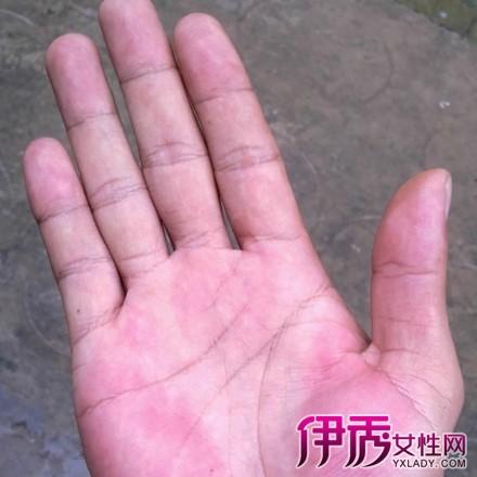 【图】肝掌跟正常手掌有什么不同 教你如何预防肝掌