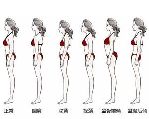 常见不良体态对人体影响之三含胸驼背
