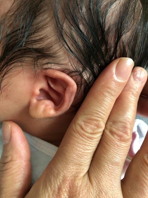 宝宝耳朵这样子,需要矫正吗?