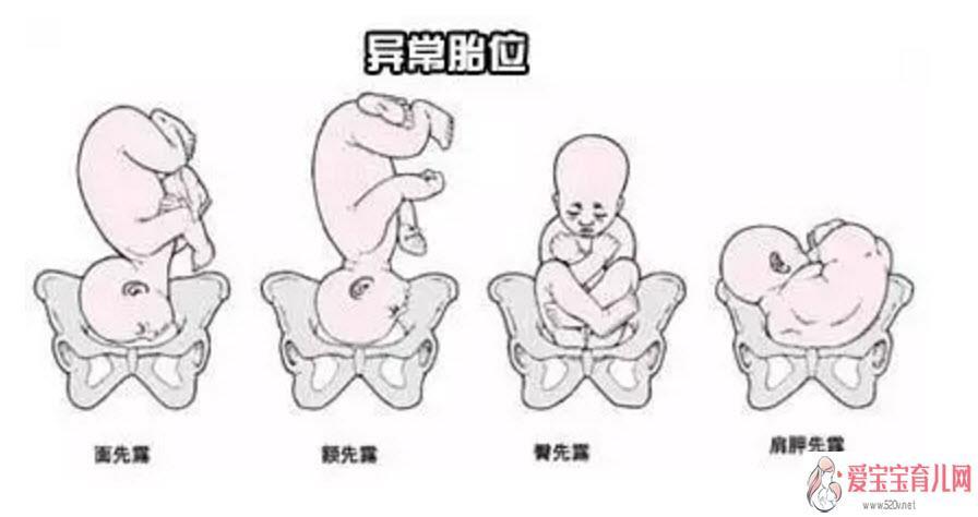 孕期胎位不正的原因 如何矫正胎位不正