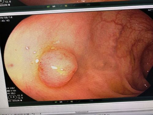 如果常规体检发现肠道腺瘤样息肉需要紧张,焦虑吗?