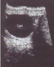 正常睾丸鞘膜囊内有少量浆液存在,性质与腹腔内浆液相 似,有滑润作用