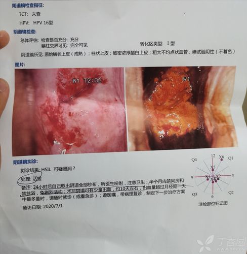 宫颈癌 阴道镜检查 [病例帖]