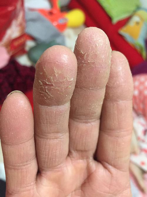 不知道什么原因我妈妈的手指,干裂脱皮疼痛.有知道的么?先谢谢各位了