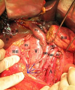 胰十二指肠切除术