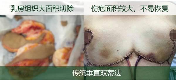 拒绝术后留疤,从不切开组织解决乳房下垂开始