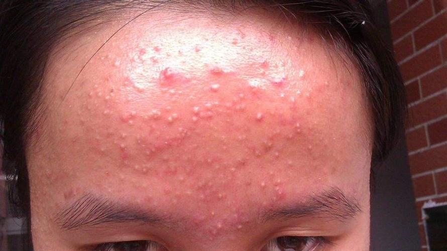 临床表现以好发于面部的粉刺,丘疹,脓疱,结节等多形性皮损为特点.